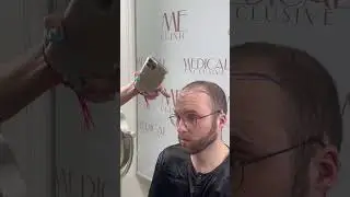 If you want undergoing a hair transplant, do not delay | Medical Exclusive #haartransplantation