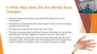 The Brain-Skin Connection Series: 9. In What Ways Does the Skin Reveal Brain Changes?