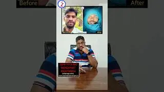 Rhinoplasty In Raipur Patna Bhubaneswar Jodhpur Bihar Odisha Chattisgarh Muzaffarpur Gaya