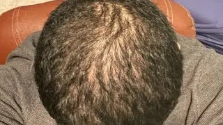 Telogen Effluvium Hair Loss: Symptoms, Causes, Treatment