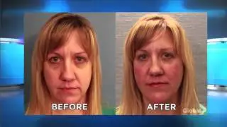 Aerolase | The Doctors | Fixing Under Eye Circles with Jason Emer, MD