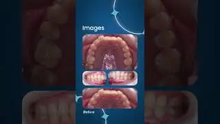 Adult Invisalign At Camden High Street Dental, London | Correcting Deep Bite, Crowding & Crossbite