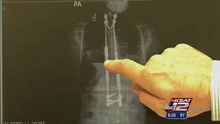 Growing Rods for Scoliosis