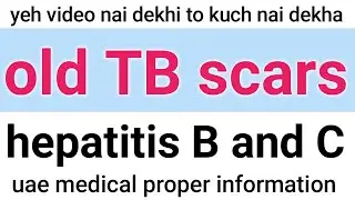 Hepatitis B and C update | old TB scars | info online