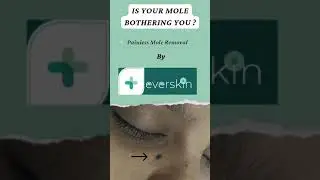 mole removal  #mole #moleremoval #clearskin #expertdoctors