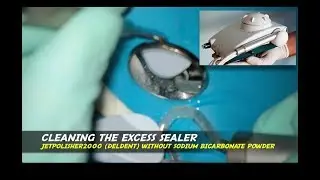 JETPOLISHER2000 (DELDENT) removal of excess endodontic bioceramic sealer post obturation molar