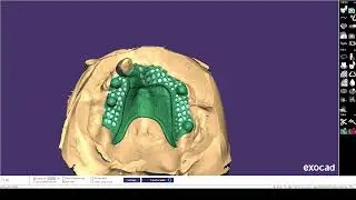 Exocad Implant Ball atachment framework design -Style GONJO