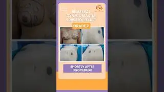 Bilateral Gynecomastia Surgery Results Grade 2 | Male Breast Reduction Procedure | Dr. Hiranmayi Jha