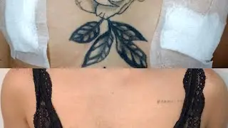 Remoção de tatuagem em pele oriental, fase final da remoção