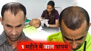 1 Month Hair Growth Results | GFC Hair Growth Treatment | Ft. Bollywood Actor