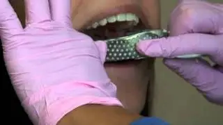 Orthodontist Rogers, AR shows an orthodontic impression