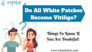 Do All White Patches Become Vitiligo?| Vitiligo Treatment In Bangalore| VITALS KLINIC | Dr Harish