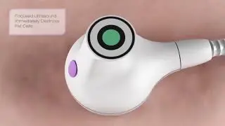 UltraShape Treatment Clip