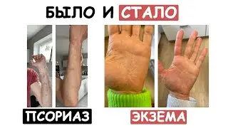 ПСОРИАЗ И ЭКЗЕМА. КАК ОТ НИХ ИЗБАВИТЬСЯ?