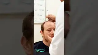 HairextreM | hair transplant Journey  !  #hairtransplant        #hairextrem       #greffedecheveux