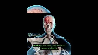 Post concussion syndrome #dizziness #vertigo #tinnitus #migraine #headache