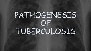 Tuberculosis : Pathogenesis