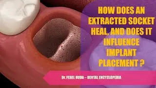 HOW DOES AN EXTRACTED SOCKET HEAL, & DOES IT INFLUENCE IMPLANT PLACEMENT?