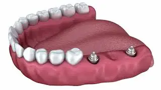 Implant Supported Bridge | Dental Restorations | Fort Bend Dental | Missouri City, Richmond TX