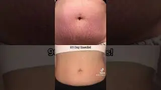 90 Day Results using Stretch Mark Free Kit ✨ #stretchmarks #stretchmarkremoval #skincareroutine