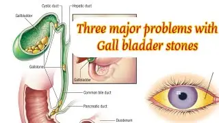 Three major problems with Gall bladder stones I पित्ताशय की पथरी से होने वाली  समस्या