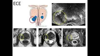 Prostate cancer staging, role of imaging