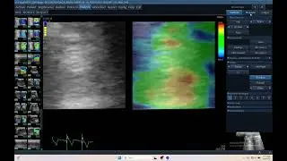 IQ 714 BRAIN ELASTOGRAPHY ULTRASOUND SR 2 27