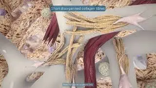 POLYTECH PrePectoral Microthane Implant Video