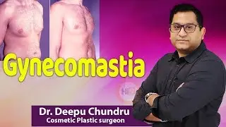 Hi9 | Gynecomastia | Dr. Deepu Chundru | Cosmetic Plastic surgeon