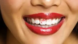 What Are The Symptoms Of Dry Mouth -  Know The Symptoms Of Dry Mouth