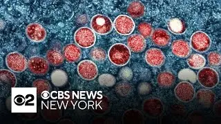New York issues Mpox warning amid outbreak in Africa