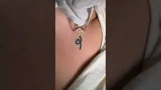 From Ink to Invisible &ndash; Tattoo Fade Fast.#removal