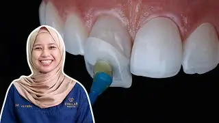 Ini Kesan Pakai Fake Veneer