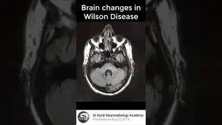 Brain changes in Wilson Disease