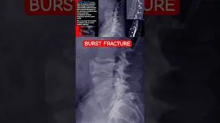 Spinal Burst Fracture #shorts #radiology #trauma