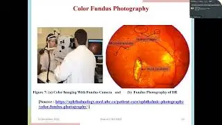 Efficient Diabetic Retinopathy Detection Using Deep Learning Approaches and Raspberry Pi -4