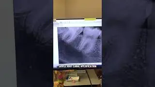 12-year-old needed a root canal. 