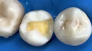 Amazing Save of a Tooth W/ A Very Big and Deep Cavity