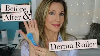 Dermaroller Update ~ 30 Day Results!