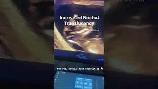 Benefits of NT scan and Causes Behind increased Nuchal Translucency