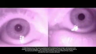 Smartphone Infrared Pupillography and Pupillometry - Supplementary video 2 [ID 331989]