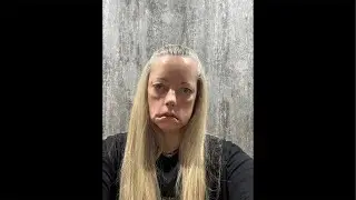 Синдром Мелькерсона Розенталя