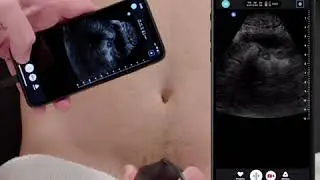 Ultrasound Education: FAST Exam Basics, Pelvic Window