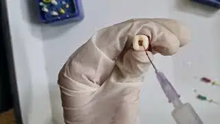 BMP - Cleaning & shaping using Stepback Technique in Second Molar