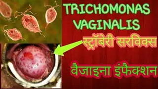 Trichomonas vaginalis, pathogenesis, lab diagnosis & treatment (in hindi)