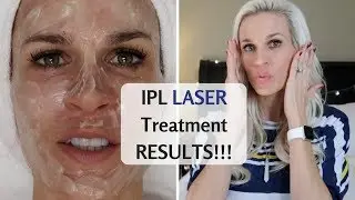 IPL LASER TREATMENT RESULTS ⭐ PhotoFacial & Sublative (Form Med Spa)