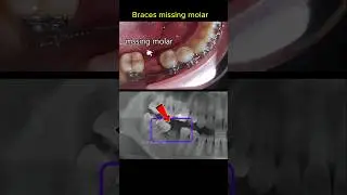 Braces for missing molar. Braces journey #braces #orthodontist #dentist