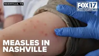 Nashville confirms first measles case since 2005, officials trace potential contacts
