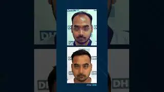 DHI Hair Transplant  |  Another week of excellent results and happy clients