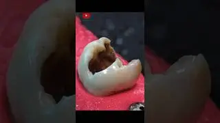 Proces korony dentystycznej